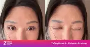 6 năm không nhắm kín mắt vì cắt mí hỏng tại phòng khám không phép