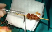 Bé 2 tuổi bị que xiên nướng đâm gần mắt, các bác sĩ kịp thời cứu chữa