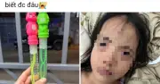 Bé 5 tuổi suýt mất thị lực vì đồ chơi thổi bong bóng chứa hóa chất độc hại