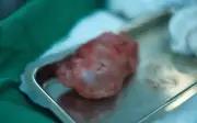 Bé gái 10 ngày tuổi thoát khỏi u quái cùng cụt hiếm gặp