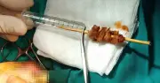 Bé gái 2 tuổi bị que xiên thịt đâm sâu vào hốc mắt, suýt mù vĩnh viễn