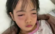 Bé gái 5 tuổi bị viêm kết mạc do dung dịch bong bóng xà phòng dính vào mắt