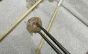 Bé gái 6 tuổi chảy máu mũi kéo dài, bác sĩ gắp ra cục giấy vệ sinh nén chặt