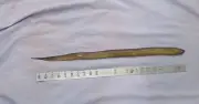 Bác sĩ phẫu thuật lấy lươn dài 50 cm trong bụng bệnh nhân