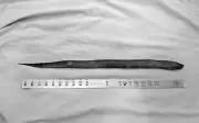 Bệnh viện Thống Nhất mổ lấy lươn dài 50cm trong ổ bụng nam bệnh nhân
