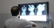 Cảnh báo cong vẹo cột sống ở trẻ: Dấu hiệu nhận biết và khám miễn phí