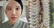 Cảnh báo: Ăn tôm sống ướp nước mắm có thể nhiễm ký sinh trùng nguy hiểm