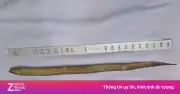 Con lươn dài nửa mét xuyên thủng trực tràng, người đàn ông đau đớn vào viện