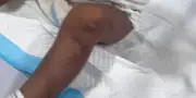 Cập nhật tình trạng bé trai bị mẹ và cha dượng bạo hành ở TP.HCM