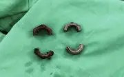 Dị vật kim loại siết chặt dương vật suốt 1 tháng: Cảnh báo cấp cứu ngoại khoa nguy hiểm