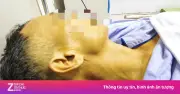 Gan tổn thương nặng vì thói quen uống rượu và dùng thuốc Nam không rõ nguồn gốc