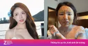 Nữ TikToker Việt mắc thủy đậu ở Dubai, khóc vì mặt biến dạng