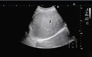 Nam sinh 15 tuổi nhập viện vì gan nhiễm mỡ nặng do uống trà sữa thường xuyên