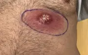 Người đàn ông bị nhện cắn, ngực thủng lỗ vì chủ quan