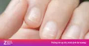 Nhìn móng tay biết bệnh? 6 dấu hiệu cảnh báo sức khỏe không nên bỏ qua