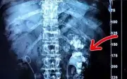 Thói quen uống trà sữa thay nước lọc khiến thận nữ bệnh nhân đầy sỏi