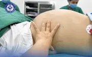 Thiếu nữ 19 tuổi mang khối u buồng trứng 30cm vì tâm lý chủ quan