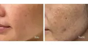 Top 5 kem mờ nám cao cấp hiệu quả, an toàn cho da hỗn hợp