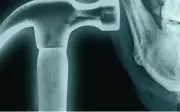 Trào lưu 'đập xương mặt' gây sốc trên TikTok: Nguy hiểm khôn lường