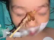 Vụ án rúng động: Bé gái 25 tháng tuổi bị que xiên thịt đâm ngược lên họng và nền sọ
