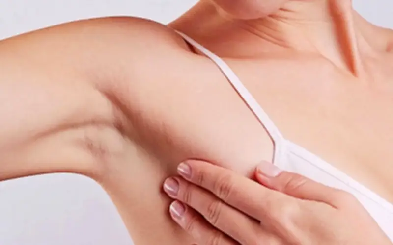 4 năm sau điều trị ung thư cổ tử cung, người phụ nữ phát hiện thêm ung thư vú