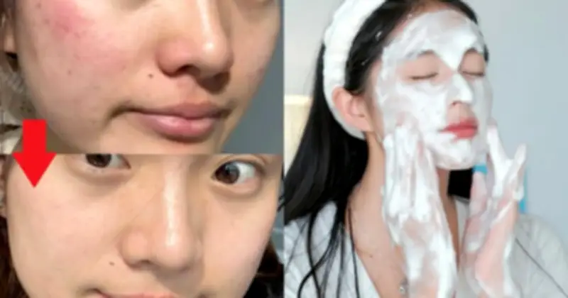 7 sữa rửa mặt cho da dầu mụn chuẩn y khoa: sạch sâu, êm dịu, ngừa mụn hiệu quả