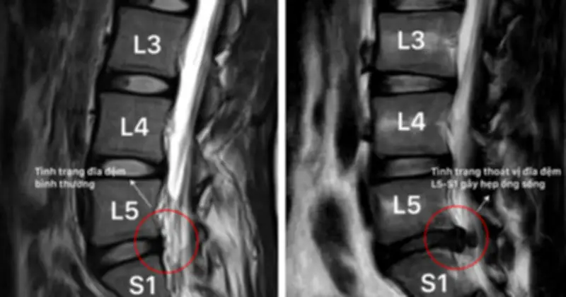 Đau lưng tê chân kéo dài: Nam sinh 23 tuổi phát hiện thoát vị đĩa đệm L5-S1