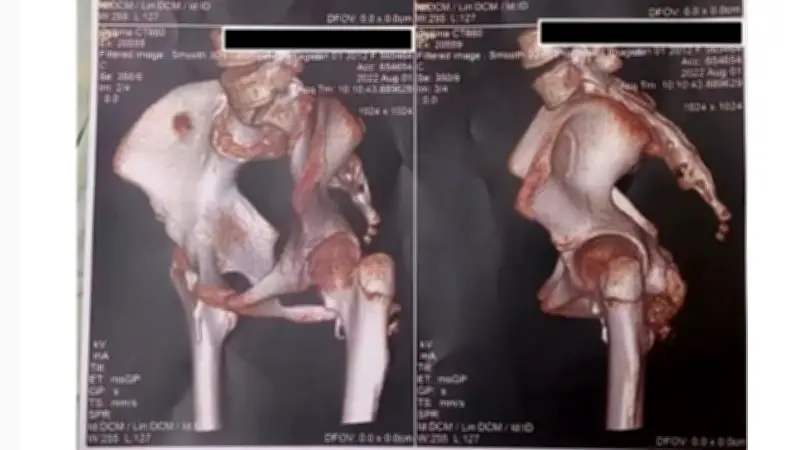 Bé gái 12 tuổi mắc hội chứng người hóa đá, thoát khỏi ca phẫu thuật nguy hiểm