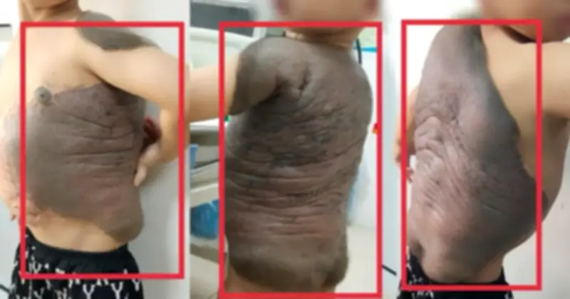 Bé trai Hà Nội 7 tuổi thoát khối u 'mai rùa' sau 6 lần đại phẫu