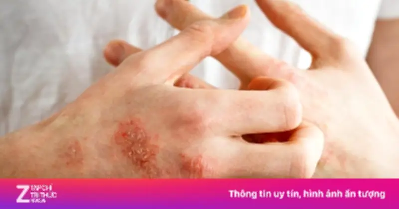Bệnh vảy nến thể mủ toàn thân: 'Cơn bão viêm' nguy hiểm đe dọa tính mạng