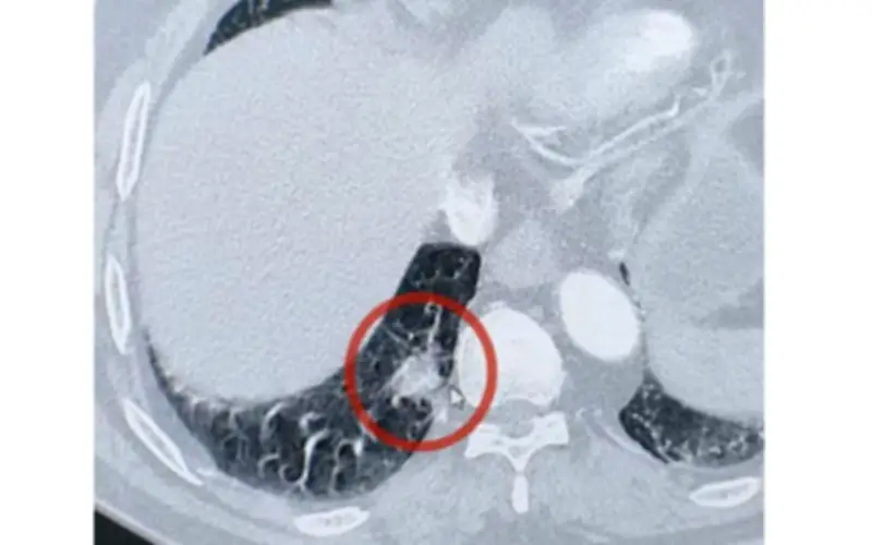 Bất ngờ: Khối u trong phổi hóa ra là đầu ớt 0,5 cm