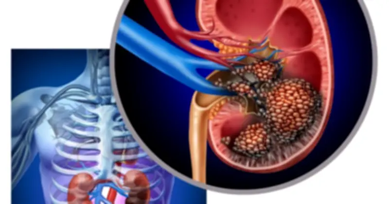 Bất ngờ phát hiện ung thư thận khi khám sức khỏe định kỳ ở tuổi 32