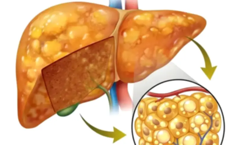 Cô gái 20 tuổi bị gan nhiễm mỡ dù không uống rượu, thủ phạm từ loại nước nhiều người Việt yêu thích