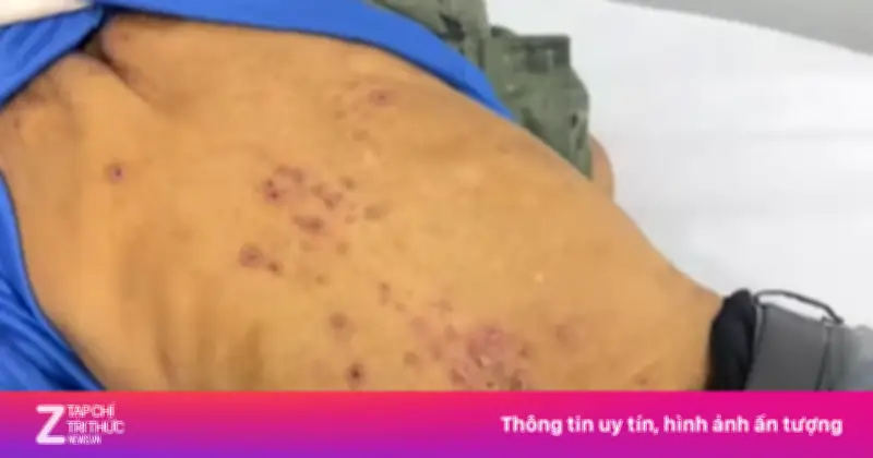 Cụ ông 77 tuổi nhiễm cùng lúc sán lá gan và giun lươn