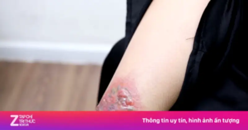 Chi hơn 85 triệu đồng xóa xăm, người phụ nữ TP.HCM đau đớn nhập viện