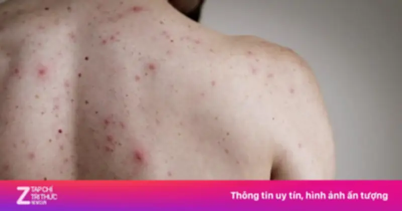 Cảnh báo giang mai bẩm sinh gia tăng, nhiều thai phụ bỏ lỡ sàng lọc