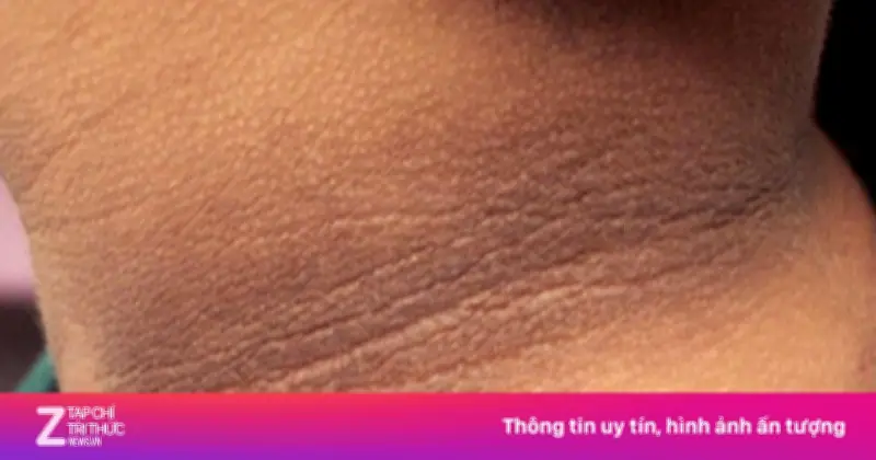 Dấu hiệu kháng insulin dễ bỏ qua: Mỡ bụng, thèm ngọt, da sẫm màu