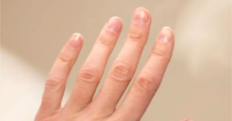 Dấu hiệu thiếu sắt trên móng tay: Bác sĩ kêu gọi đi khám ngay