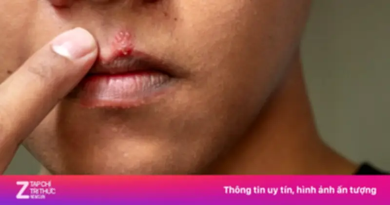 Dấu hiệu ung thư miệng dễ bị bỏ qua do nhầm với bệnh răng miệng