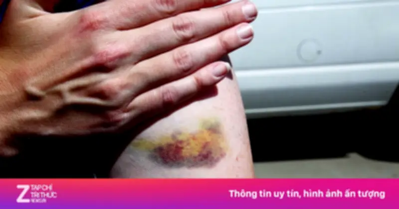 Dấu hiệu xơ gan giai đoạn đầu dễ bỏ qua: Mệt mỏi, sụt cân, ngứa da