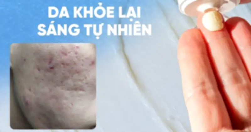 Kem Scar Esthetique của Rejuvaskin: Giải pháp làm mờ sẹo rỗ do mụn an toàn, hiệu quả