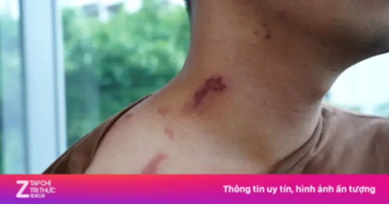 Kiến ba khoang mang độc tố như rắn hổ mang, xử trí sai nguy hiểm