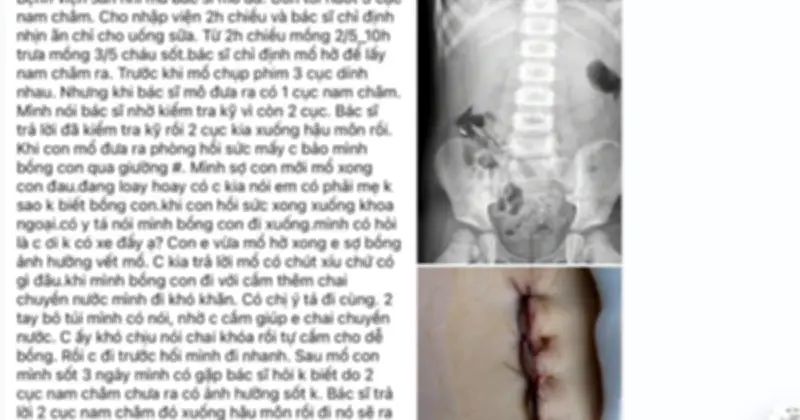 Nghệ An yêu cầu báo cáo vụ bé nuốt nam châm, mổ lấy 1 viên
