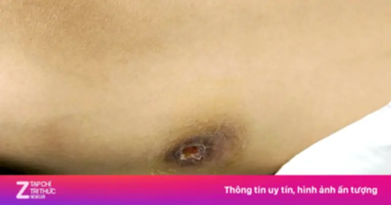 Nhiễm khuẩn Whitmore 'ăn thịt người', người phụ nữ nguy kịch sau 5 ngày