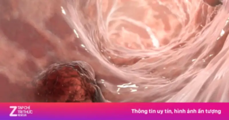 Phụ nữ 52 tuổi ung thư đại trực tràng di căn vì thói quen tiết kiệm