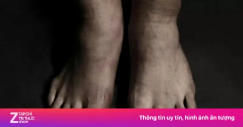 Phía sau đôi chân biến dạng của Son Heung-min: Nhỏ bé nhưng phi thường