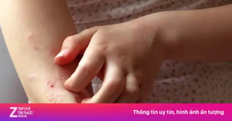 Phát hiện hai con giun sống dài 10 cm trong khối u tay người phụ nữ