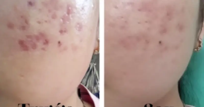 Sẹo thâm có tự hết không? Chuyên gia giải đáp và cách cải thiện