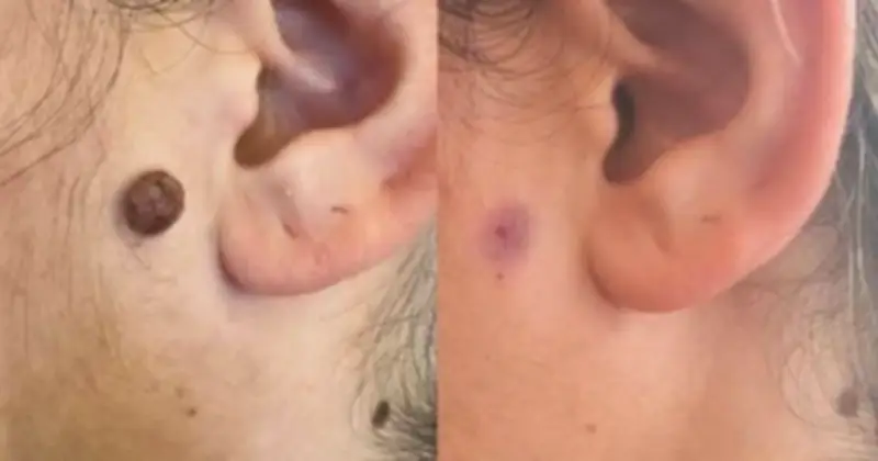 Sẹo thâm do tẩy nốt ruồi mãi không hết: Chuyên gia chỉ cách cải thiện