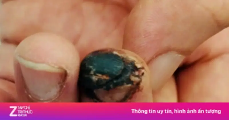 Tự đắp lá vào vết thương do cành cây, người bệnh tử vong vì uốn ván